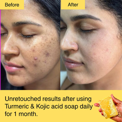 HORIZONLUX™ Turmeric & Kojic Acid Soap