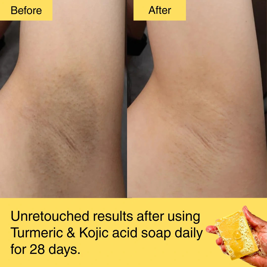 HORIZONLUX™ Turmeric & Kojic Acid Soap