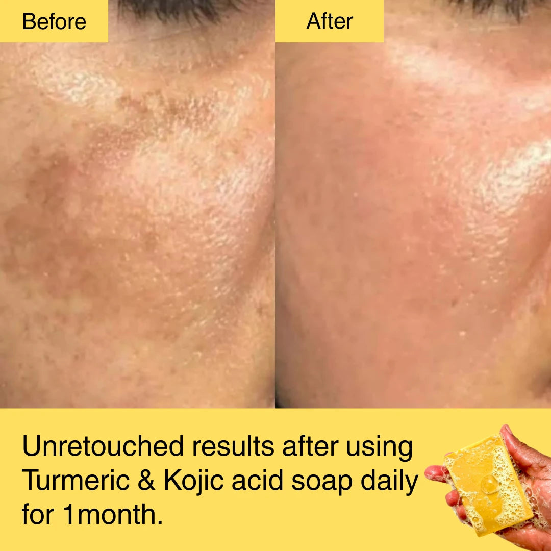 HORIZONLUX™ Turmeric & Kojic Acid Soap