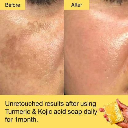 HORIZONLUX™ Turmeric & Kojic Acid Soap